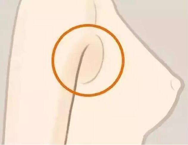 減副乳，瘦手臂一招就解決！