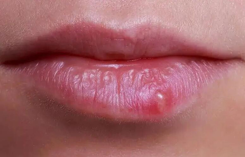 紋唇后起泡怎么辦？南寧紋唇培訓(xùn)學(xué)校教你方法