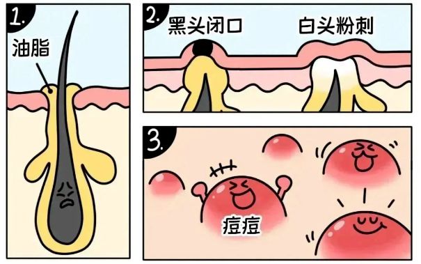 不同部位閉口形成的原因，南寧美容護(hù)膚學(xué)校解答